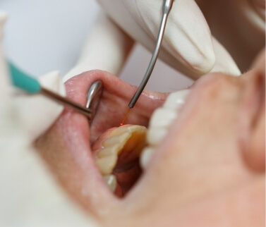 Close up of dental patient receiving laser gum treatment