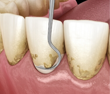 Illustrated dental scaler clearing plaque buildup from teeth