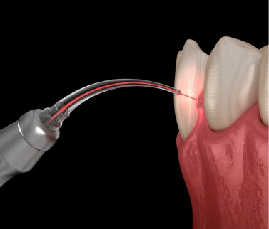 Illustrated dental laser treating the gums