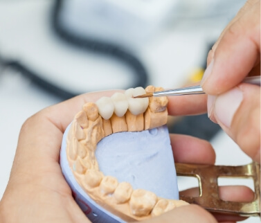 Ceramist crafting a dental bridge