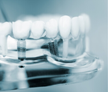 Model of the mouth with two dental implants