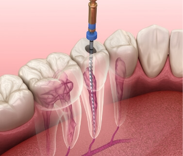 Illustrated dental instrument treating the inside of a tooth